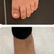Surgical Repair of Shorten/Floating toe