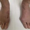 3 Months post bunion surgery